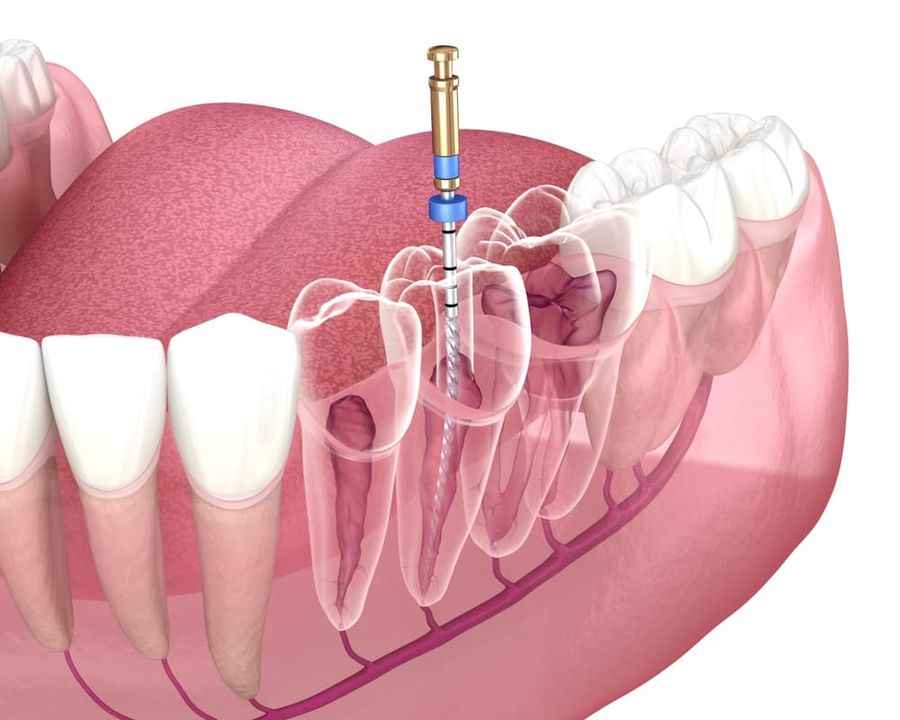 7 Signs You Need a Root Canal - Don't Ignore These Symptoms