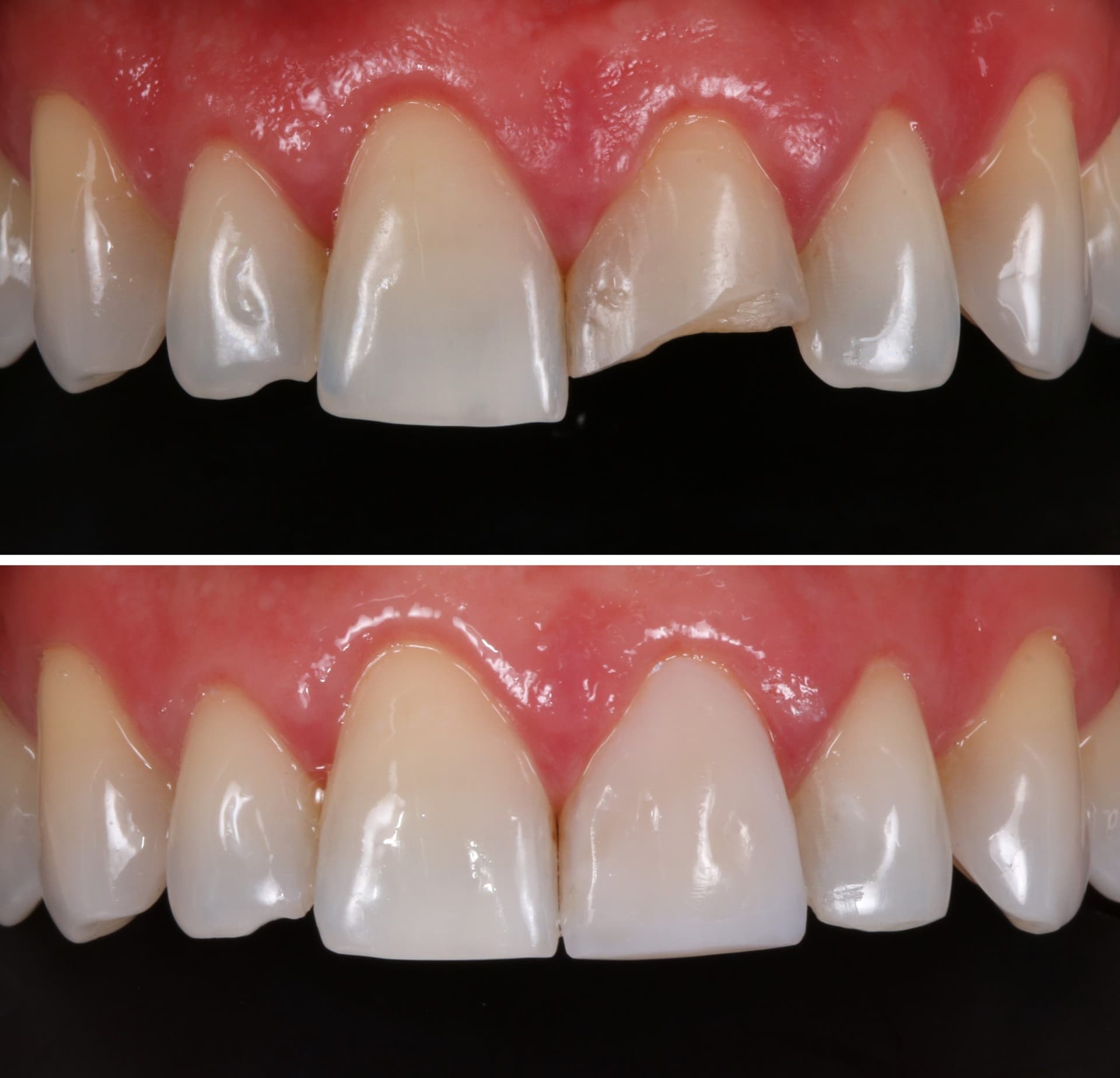 Composite Restoration