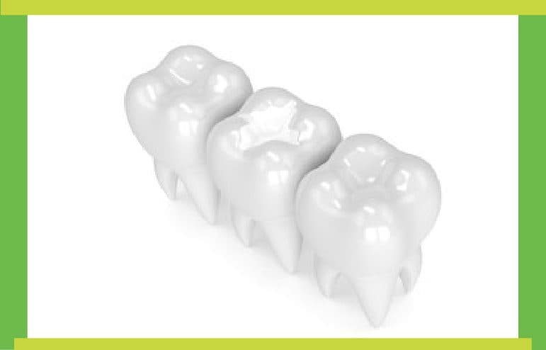 Composite Restoration