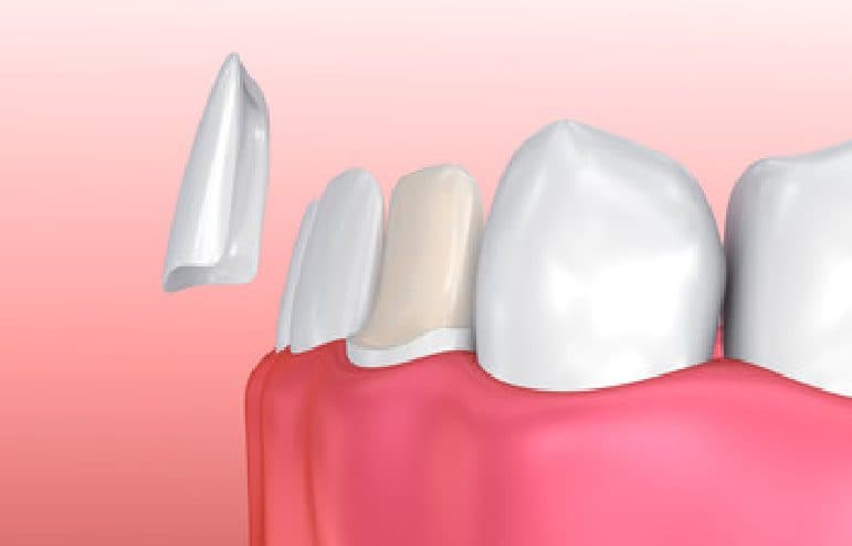 Dental Veneers