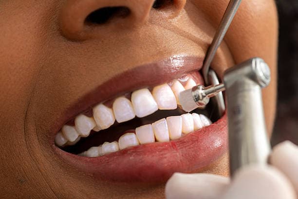 Teeth Cleaning / Scaling & Polishing