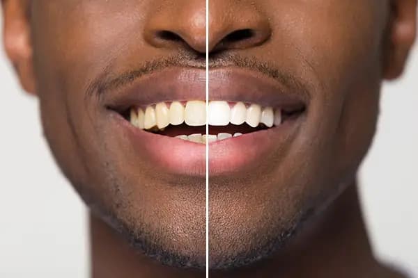 Teeth Whitening